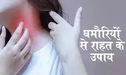 जानें क्यों गर्मियों में हो जाती हैं घमौरियां, ऐसे करें बचाव