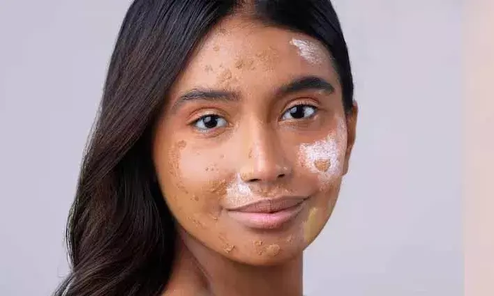 शरीर पर सफेद धब्बे इस खतरनाक और जानलेवा बीमारी के हैं संकेत, करवाएं ये टेस्ट