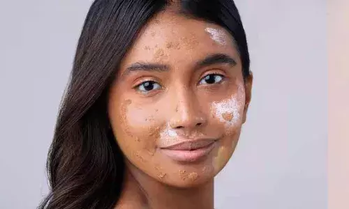 शरीर पर सफेद धब्बे इस खतरनाक और जानलेवा बीमारी के हैं संकेत, करवाएं ये टेस्ट