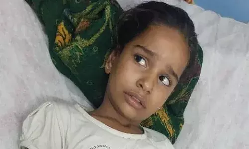 Krt se बालिका झुलसी