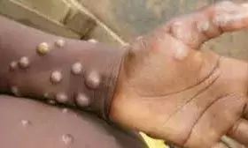 मंकीपॉक्स का खौफ, एक संदिग्ध को किया गया आइसोलेट, स्वास्थ्य