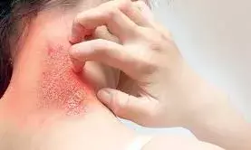 दाद की खुजली और जलन से आराम दिलाएंगी घर में रखीं ये चीजें