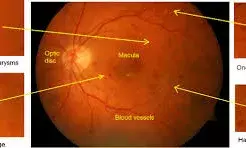 तेज से बढ़ रहे शुगर के मरीज: शुरुआत में पहचानना मुश्किल; जारी हुई डायबिटिक रेटिनोपैथी स्क्रीनिंग गाइडलाइन