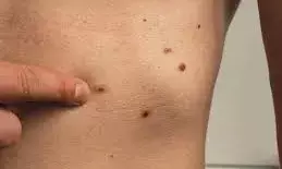 शरीर के किसी भी तिल में अगर हो रहा बदलाव, हो सकती है ये गंभीर बीमारी, जानिए कैसे करें बचाव