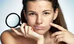 क्या आपके चेहरे पर भी बार-बार निकलते हैं पिंपल, डॉक्टर ने बताया इसका कारण और इलाज