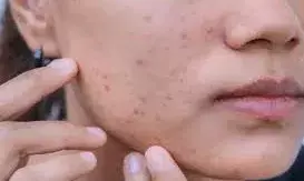 सर्दियों में स्किन का लाल होना और सूजन इन बीमारियों का हो सकता है लक्षण, डॉक्टर से जानें बचाव के तरीके