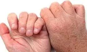 सर्दी में भी हाथ-पैर नजर आते हैं डार्क, तो अपनाएं ये नुस्खे