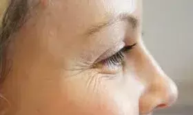 आंखों के नीचे नजर आ रही हैं झुर्रियां, तो अपनाएं ये टिप्स