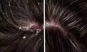 बालों से डैंड्रफ निकालने का रामबाण इलाज, आप भी करें फॉलो बालों से डैंड्रफ निकालने का रामबाण इलाज, आप भी करें फॉलो