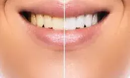 दांतों की समस्या को दूर करता है सरसों का तेल, जानें इस्तेमाल का तरीका दांतों की समस्या को दूर करता है सरसों का तेल, जानें इस्तेमाल का तरीका