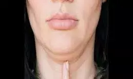 डबल चिन कम कर रहा है चेहरे की खूबसूरती, दूर करने के लिए इन उपायों को अपनाएं