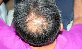 तेजी से झड़ते बालों ने बढ़ा दिया गंजेपन का खतरा? ये ड्रिंक्स दिलाएंगे समस्या से छुटकारा तेजी से झड़ते बालों ने बढ़ा दिया गंजेपन का खतरा? ये ड्रिंक्स दिलाएंगे समस्या से छुटकारा