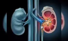 इन 5 आदतों को अपनाकर किडनी स्टोन के खतरे को कम करें