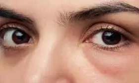 आंखों का हार्पीज़ होने के बाद कैसी होनी चाहिए डाइट? जानिए एक्सपर्ट से