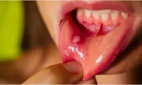 मुंह के छालों से है परेशान तो अनदेखा करने की गलती न करें