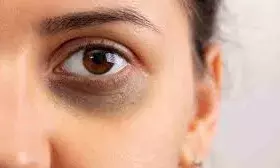 आंखों के डार्क सर्कल को कम करेंगी ये 4 नेचुरल चीजें, जानिए कैसे करें इस्तेमाल