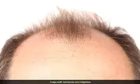 पुरुषों में गंजेपन का संकेत हो सकते हैं ये 3 लक्षण, न करें नजरअंदाज