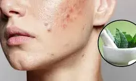 दाग-धब्बे हो जाएंगे कम, नीम के पत्ते को चेहरे पर इस तरह लगाएं