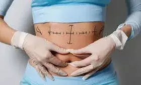 वजन कम हो गया लेकिन लटक गई है स्किन? बॉडी कॉन्टूरिंग सर्जरी है इलाज़,एम्स में मिलती है सुविधा वजन कम हो गया लेकिन लटक गई है स्किन? बॉडी कॉन्टूरिंग सर्जरी है इलाज़,एम्स में मिलती है सुविधा