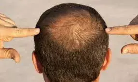 दोगुनी तेजी से सिर पर उगने लगेंगे बाल, आज ही डायट में शामिल करें ये पावरफुल चीजें दोगुनी तेजी से सिर पर उगने लगेंगे बाल, आज ही डायट में शामिल करें ये पावरफुल चीजें