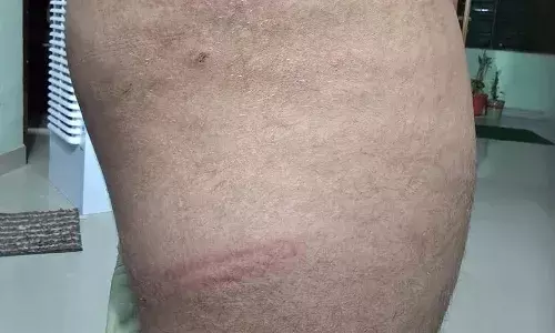 कच्चे आम तोड़ने पर टीचर ने बच्चे को पीटा, डर के मारे कर दी शौच