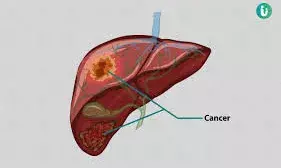 लिवर कैंसर क्यों होता है? जाने  कैसे करें बचाव?