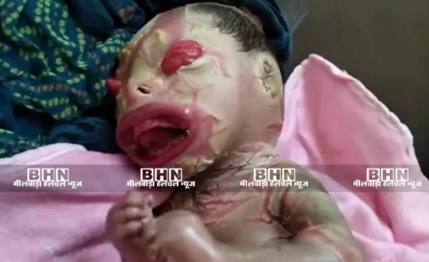 असामान्य मुंह की बनावट वाले बच्चे के जन्म से मचा हड़कंप असामान्य मुंह की बनावट वाले बच्चे के जन्म से मचा हड़कंप