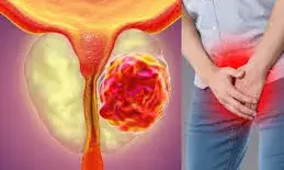 प्रोस्टेट कैंसर के अलावा पुरुषों में इन कैंसर का भी खतरा