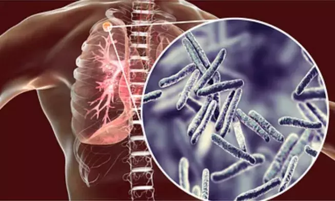 अब 6 माह में होगा-टीबी का इलाज, भारत में ट्रायल से उपचार की संभावना अब 6 माह में होगा-टीबी का इलाज, भारत में ट्रायल से उपचार की संभावना