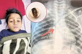 बच्चे ने खेलते समय निगला सेल, फेफड़ों में फंसा,एआई से पूछते समय आया पकड़ में