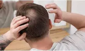 बालों को हेल्दी रखने के लिए डाइट का रखे  खास ख्याल