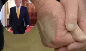 हाथ पर चोट के निशान, पैरों में सूजन; इस बीमारी से पीड़ित पाए गए डोनाल्ड ट्रंप