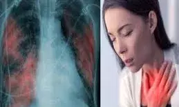 बदलती जीवनशैली बन रही फेफड़ों के कैंसर का कारण, युवा भी नहीं सुरक्षित