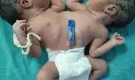 फिर जन्मी अनोखी बच्ची... नवजात के दो सिर, चार हाथ और दो दिल, डॉक्टर भी हैं हैरान