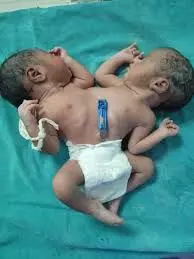 फिर जन्मी अनोखी बच्ची... नवजात के दो सिर, चार हाथ और दो दिल, डॉक्टर भी हैं हैरान