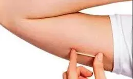 भीलवाड़ा में जल्द शुरू होगी नई गर्भनिरोधक सुविधा: सब डर्मल कॉन्ट्रासेप्टिव इम्प्लांट