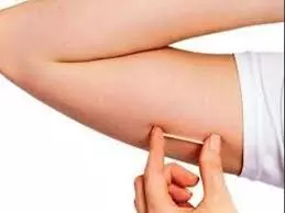 भीलवाड़ा में जल्द शुरू होगी नई गर्भनिरोधक सुविधा: सब डर्मल कॉन्ट्रासेप्टिव इम्प्लांट