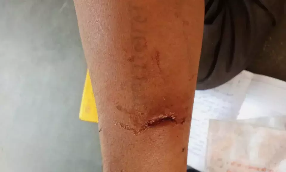 मालासेरी गांव में आक्रामक बंदर का आतंक, कई लोग घायल, लोग हदशत में