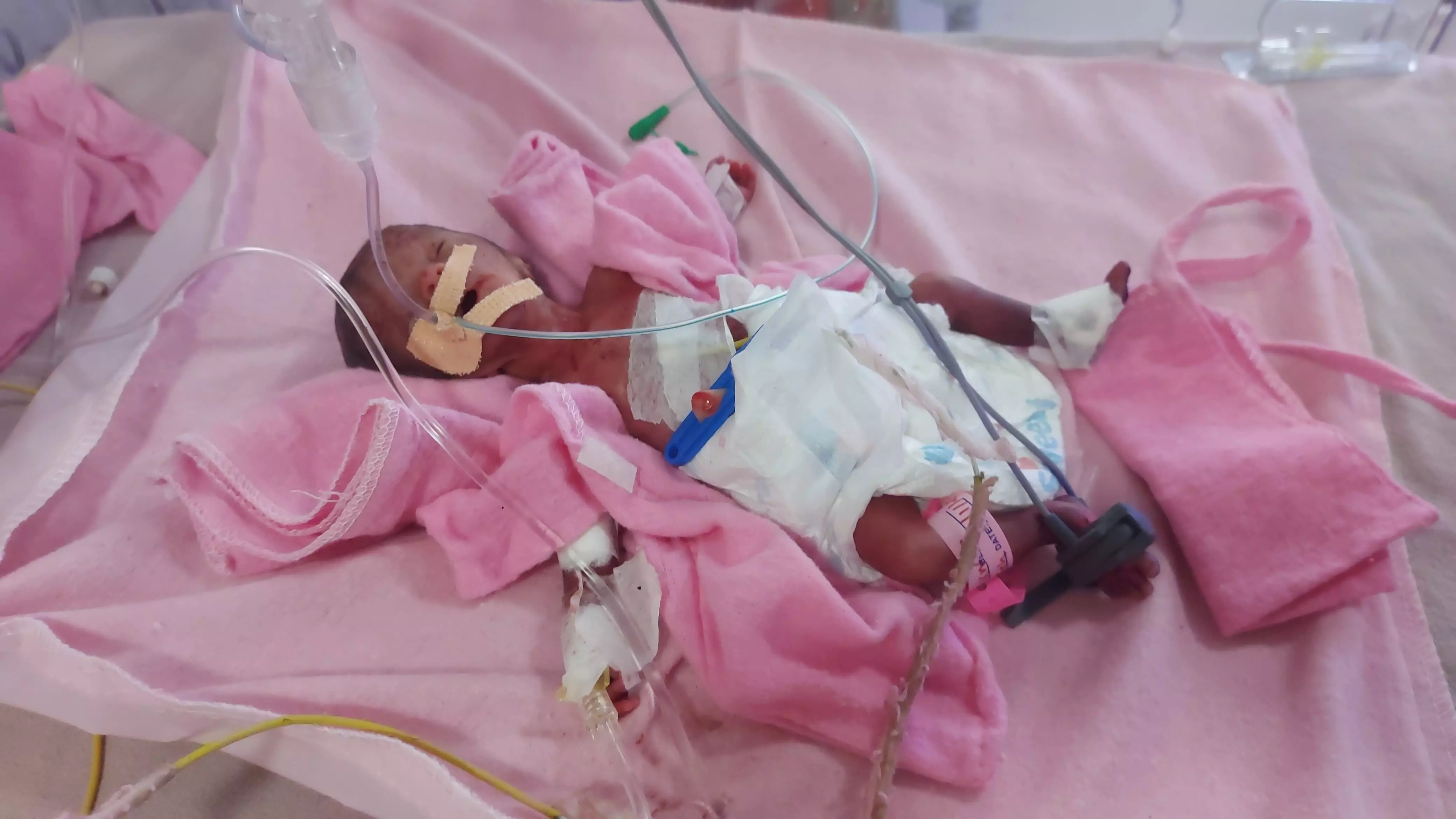 जीवन और मौत के बीच झूलती 600 ग्राम की जिंदगी,महात्मा गांधी अस्पताल में लावारिस छोड़ी गई नवजात जीवन और मौत के बीच झूलती 600 ग्राम की जिंदगी,महात्मा गांधी अस्पताल में लावारिस छोड़ी गई नवजात