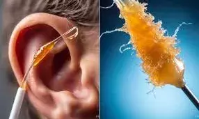 सावधान! कान की गंदगी बन सकती है बहरेपन का कारण: घर बैठे चुटकियों में साफ करने का अचूक नुस्खा