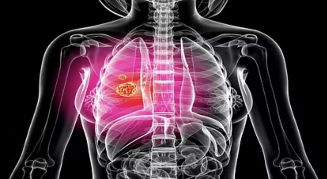 विश्व फेफड़ा दिवस : दिल-दिमाग का मरीज बना सकती है जोर से खर्राटे लेने की आदत, एम्स ने किया अध्ययन